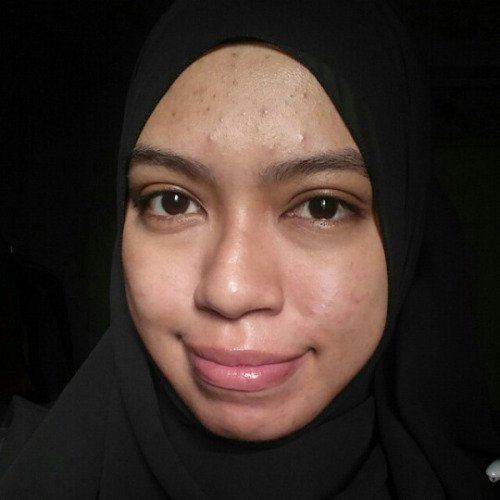 penyebab bruntusan di wajah