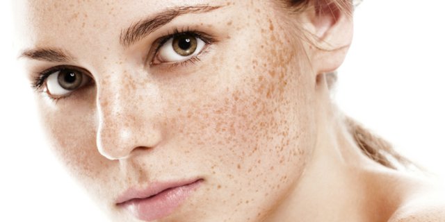 pengertian freckles dan penyebabnya
