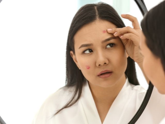 berbagai mitos mengenai jerawat