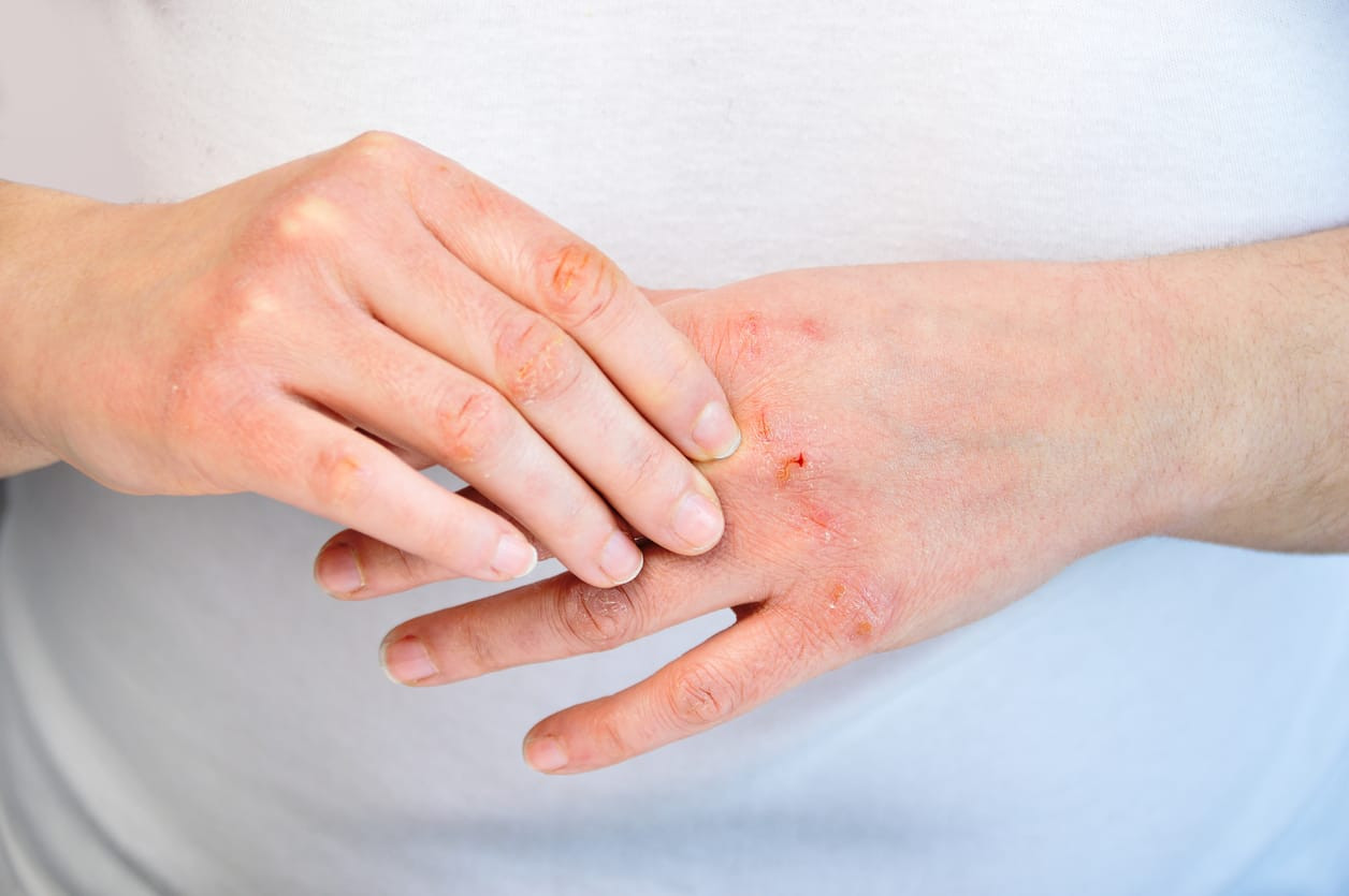 kenali munculnya gejala scabies 