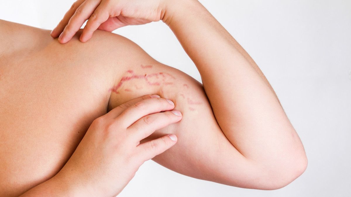 hal yang dapat menghilangkan stretch mark di kulit