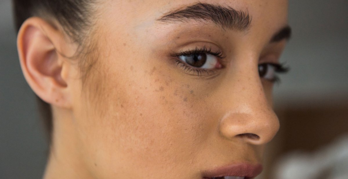 cara membedakan berbagai macam pigmentasi kulit