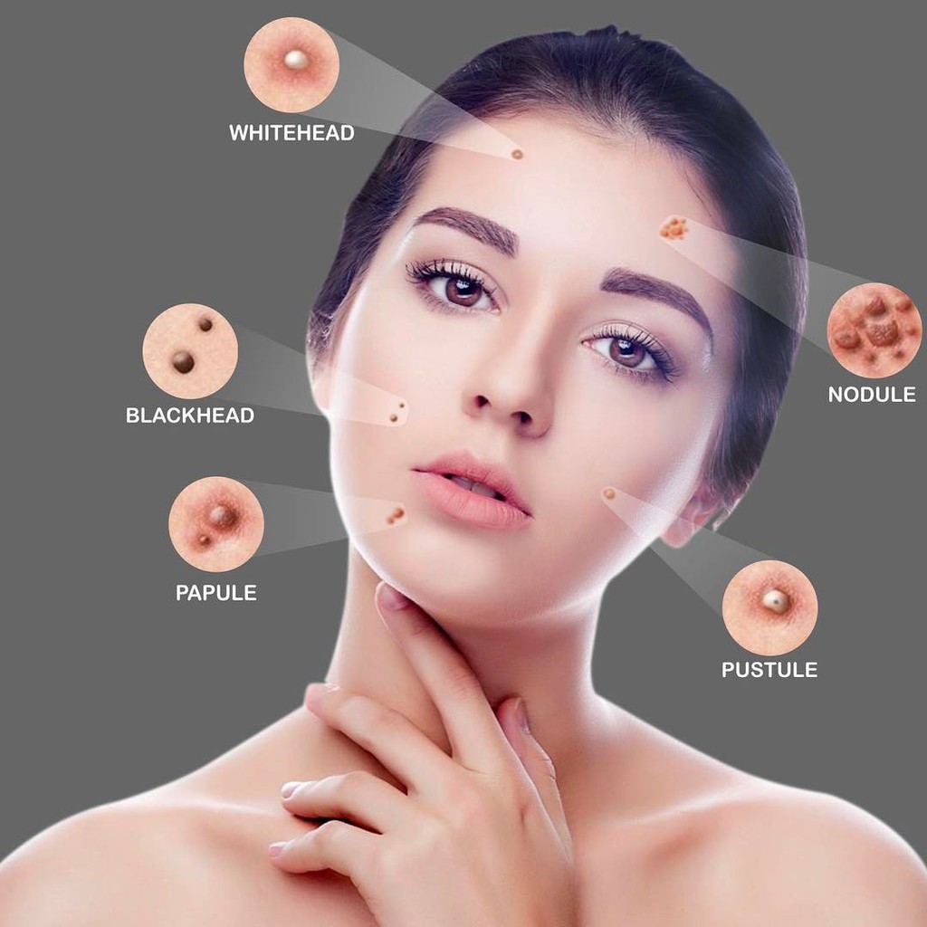 sudah tau ini loh jenis-jenis jerawat