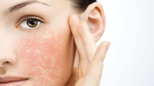 tips merawat kulit sensitif dengan tepat