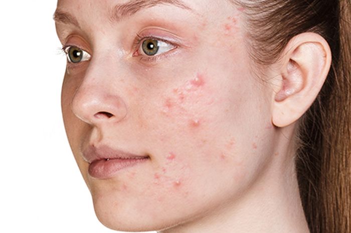 salah perawatan wajah bisa sebabkan jerawat