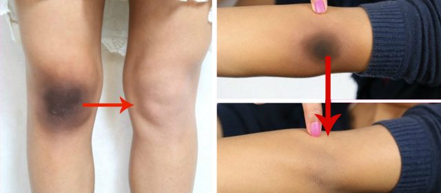 tips atasi lutut dan siku hitam