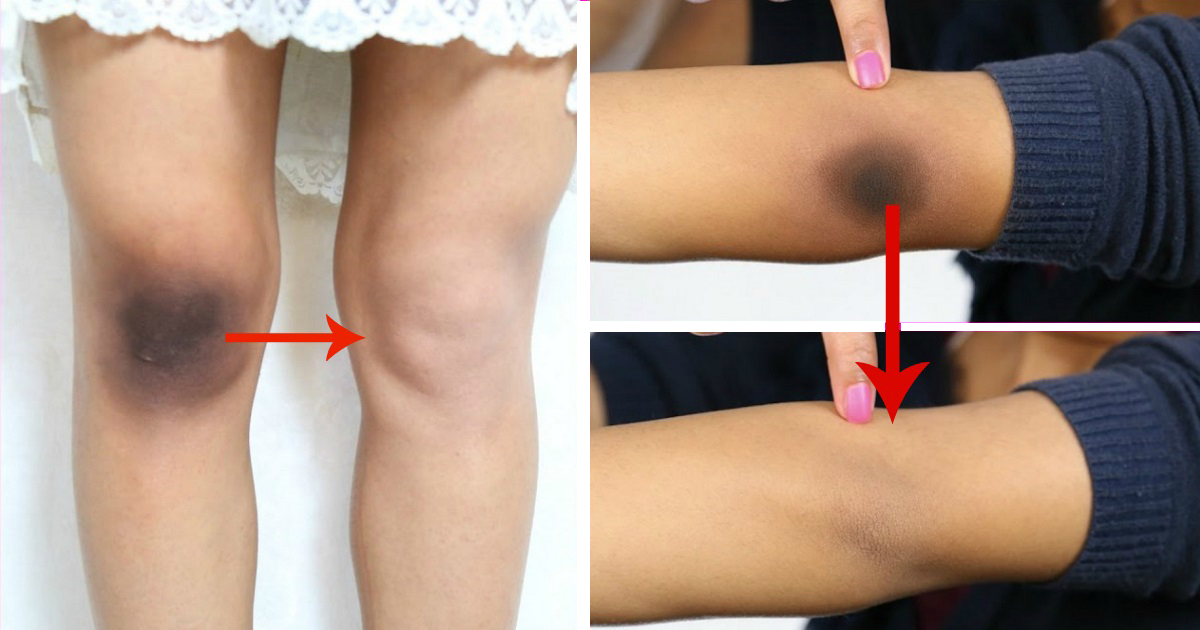 tips atasi lutut dan siku hitam