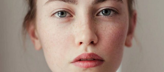 perbedaan freckles dengan flek hitam
