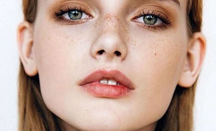 freckles tidak berbahaya