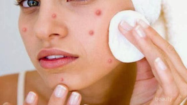 produk skincare terbaik untuk acne prone