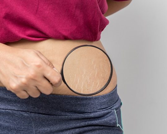 Apa Penyebab Stretch Mark?