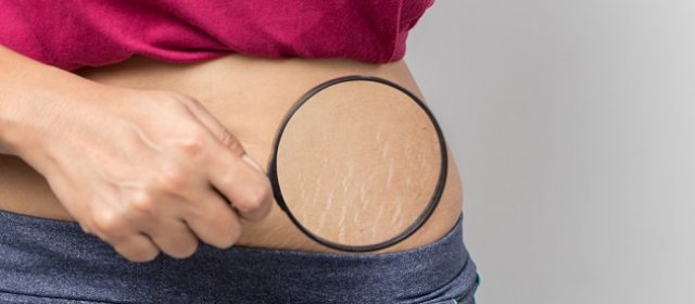 Solusi atasi stretch mark di perut