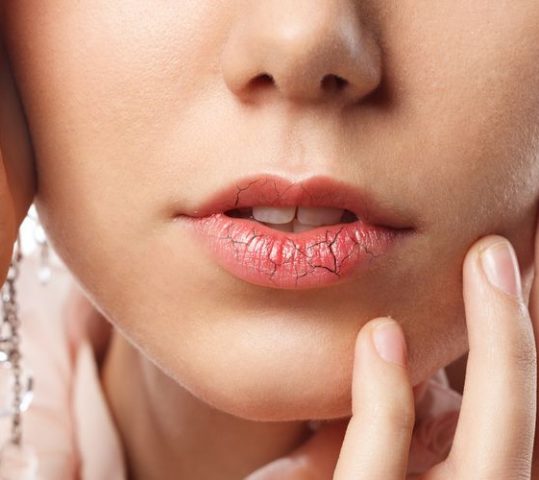 Penyebab dan Cara Mengatasi Bibir Kering