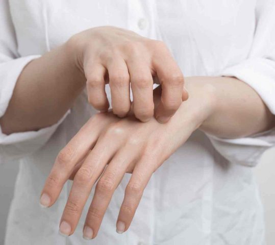 Gejala Scabies yang Perlu di Ketahui