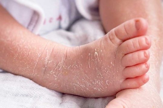 Tips Mengatasi Kulit Bayi Mengelupas