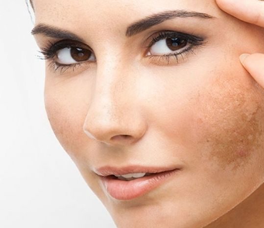 Skincare Terbaik untuk Atasi Flek Hitam