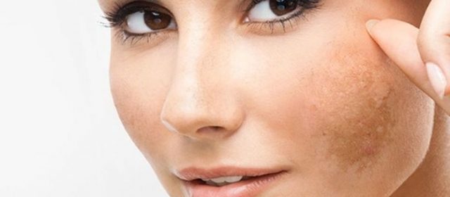 Skincare Terbaik untuk Atasi Flek Hitam