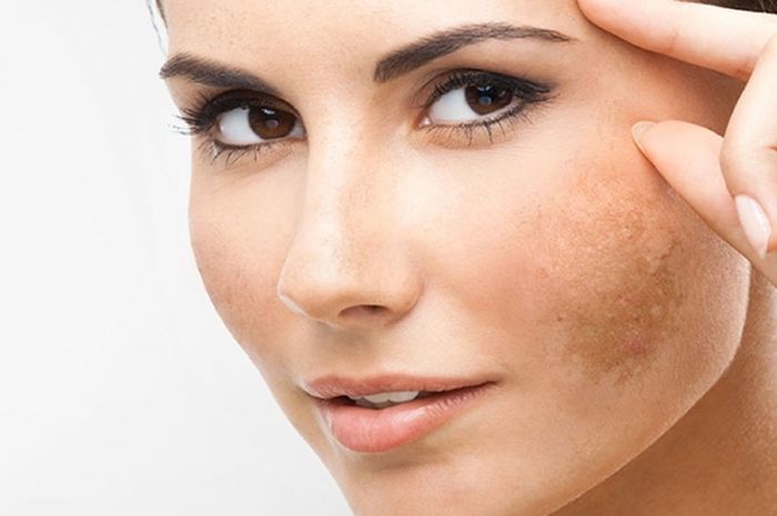 produk skincare rekomendasi atasi flek hitam